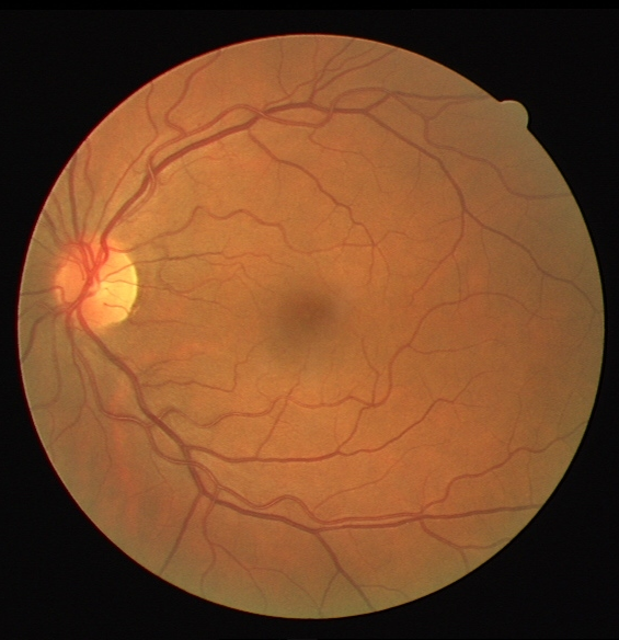 Original fundus image